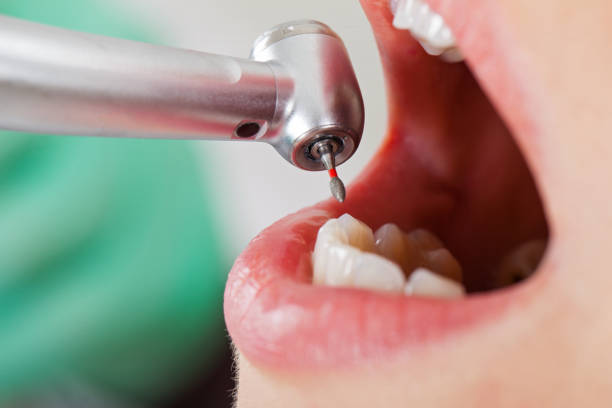 Best Emergency Treatment for Dental Infections or Abscesses in Orange, TX